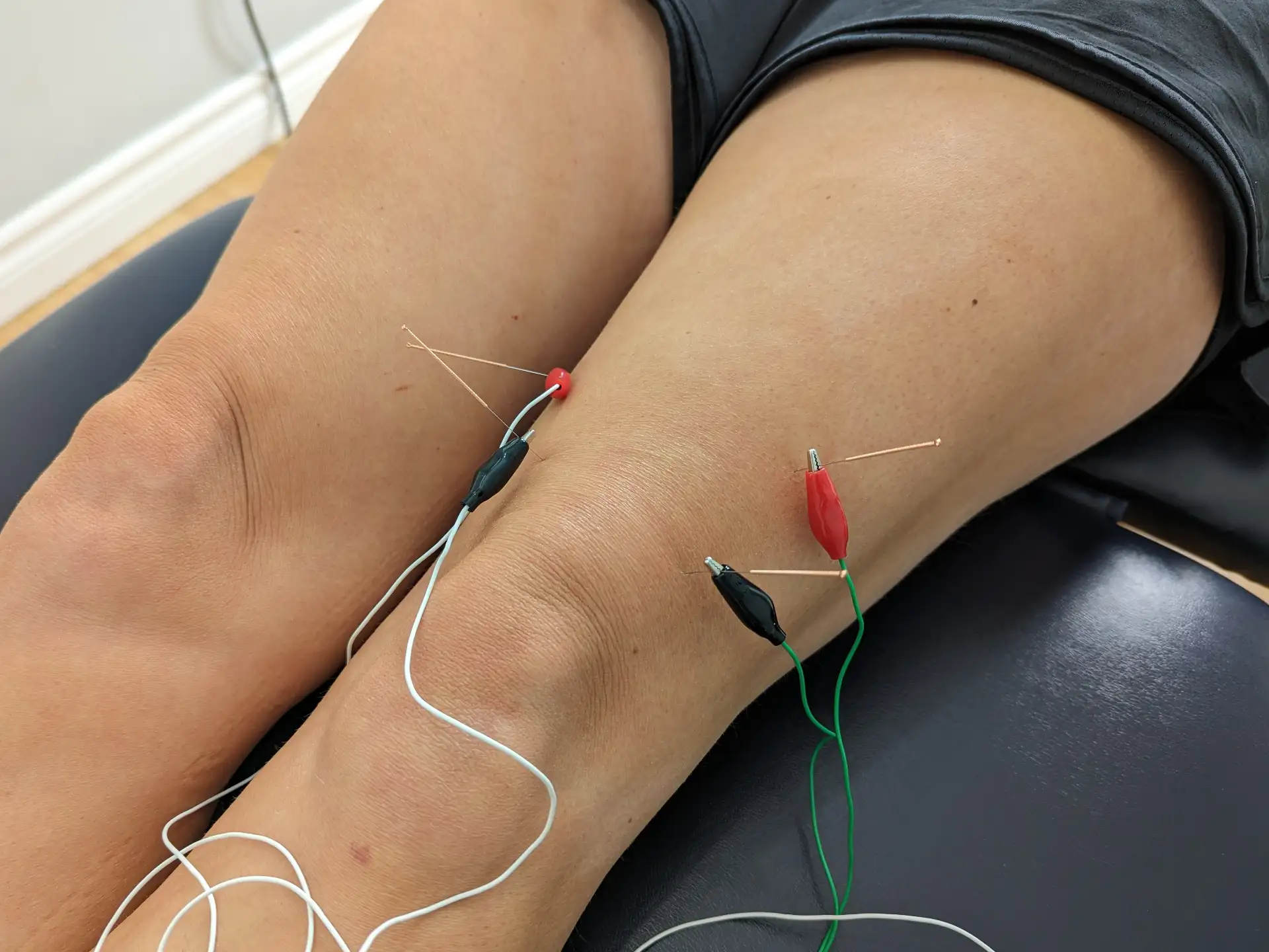 middlesex spine and sport medical acupuncture main mount brydges